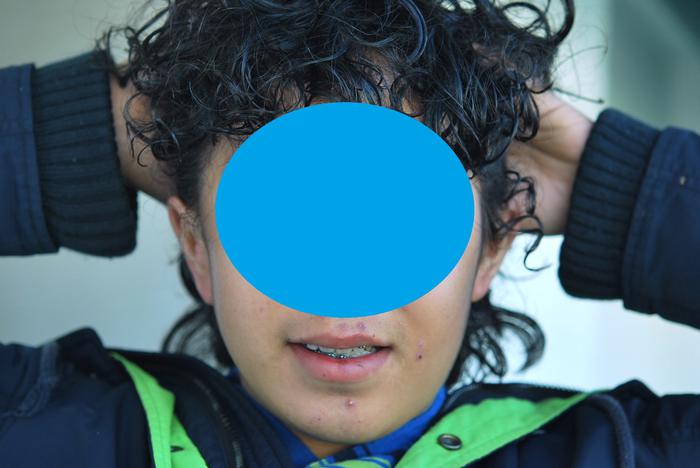 Microtia bilateral